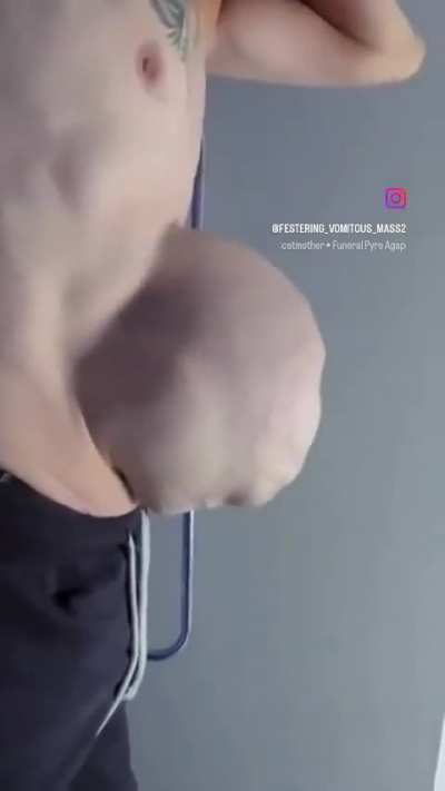 Ventral hernia