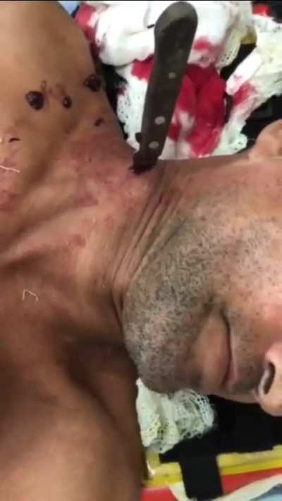 Stab wound to the neck an inch away from the carotid artery!