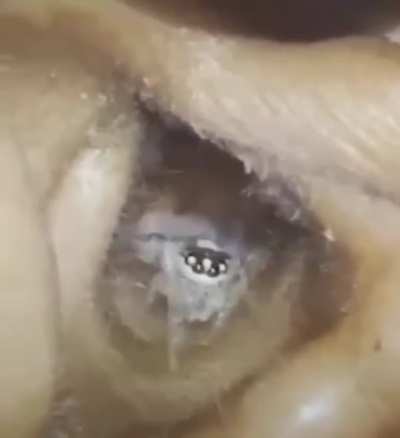 Spider in an ear canal. Happy Halloween!