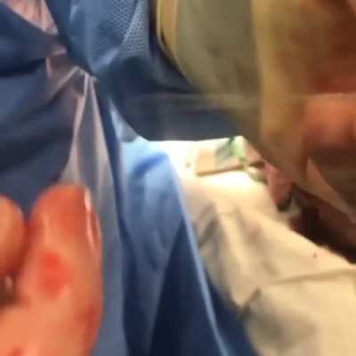 Amputation using Gigli saw. This video shows a below-the-knee amputation (BKA) due to diabetic neuropathy, specifically charcot foot.