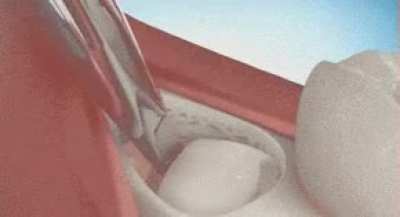 How a wisdom tooth is removed