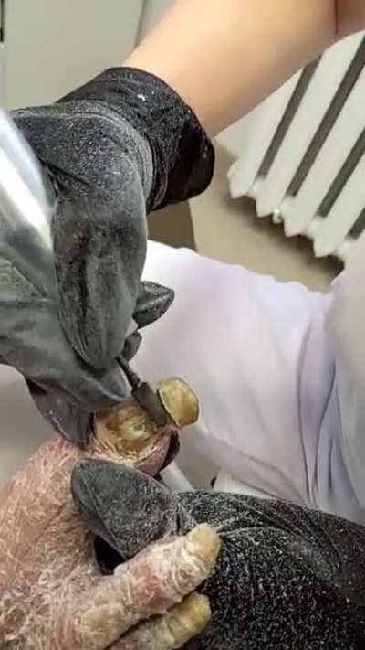 Extreme pedicure