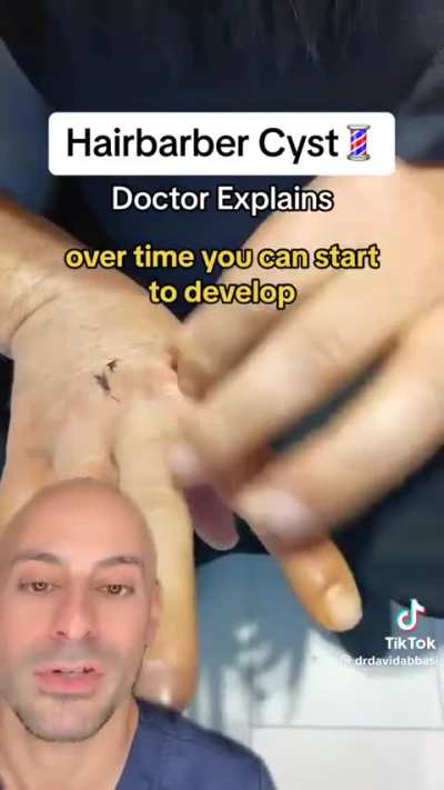 Hairbarber cyst