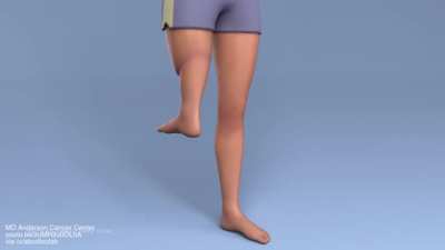 What is rotationplasty?