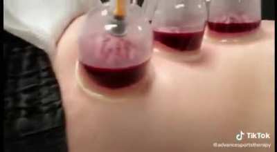 Cursed_Cupping
