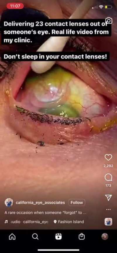 Multiple contacts being delivered from an eyeball. Remember to take out your contacts before bed kids&hellip;.