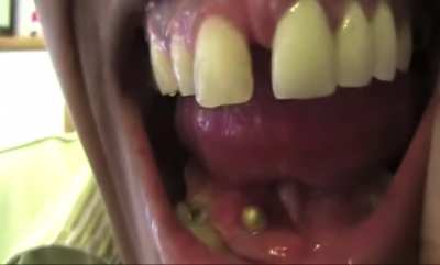 Really thought it was a piercing at first..