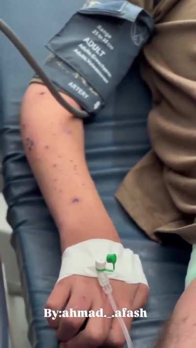 The child Waleed Khalaf is suffering from the spread of chickenpox throughout his body and severe acute malnutrition. He has become extremely weak and urgently needs to travel outside the Gaza Strip to receive treatment and be saved before it is too late.