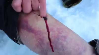 Vlad calmly doing emergency hematoma surgery on himself in the snowy wilderness