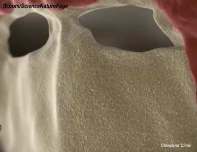 How Brain Tumors are removed
