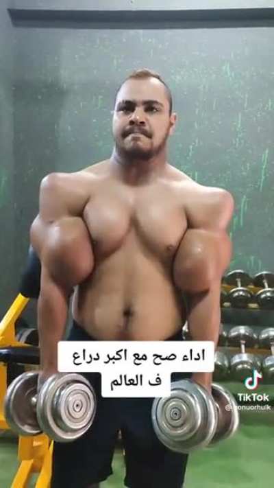 This guy's appearance after Synthol Injections