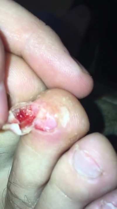 My case of runner&rsquo;s toe...