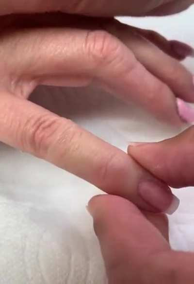Applying prosthetic finger tip with water.