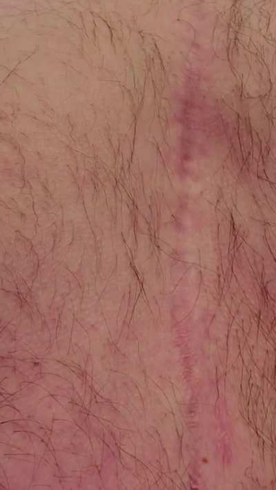 My partially artificial heart seen through my chest.