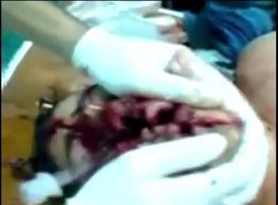 2009 FACE SPLIT DIVING ACCIDENT