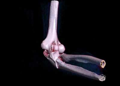 Broken arm