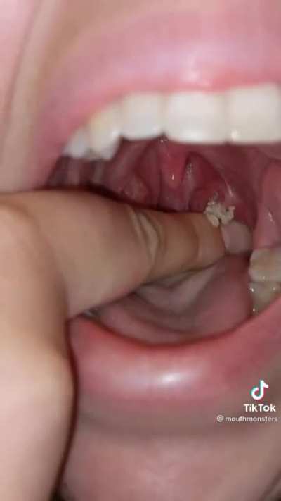 Yum mouthpimple