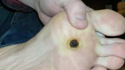 DIY high-voltage electrosurgery on my plantar wart
