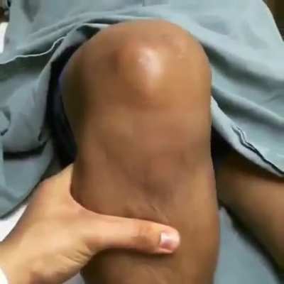 Holy positive anterior drawer