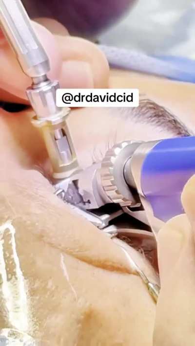 LASIK eye surgery