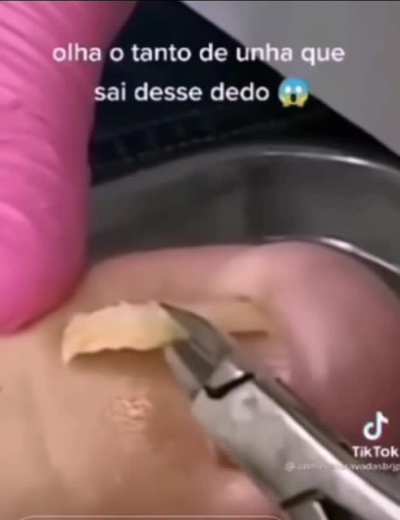 crazy ingrown tornail