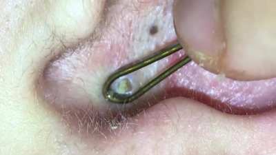 Ear pop