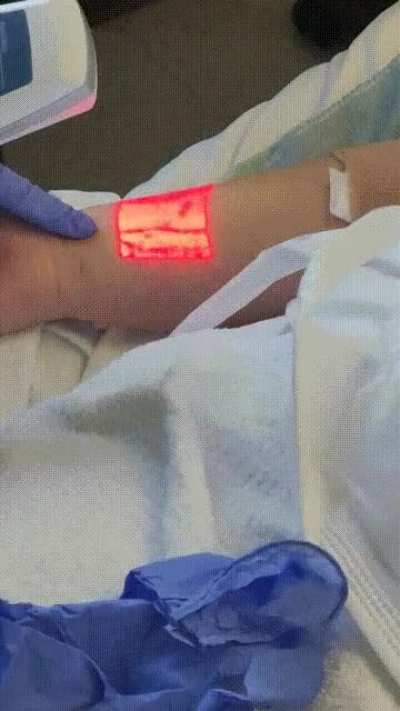 This device that can show you where your veins are