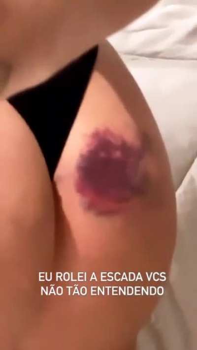 Manoo tadinha... Viih Tube... 🥺🙏 Oremos pra esse bumbum sarar r&aacute;pidinho...