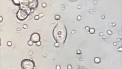 Cancer Cells Being Brutally Destroyed By Genetically Engineered T-cells