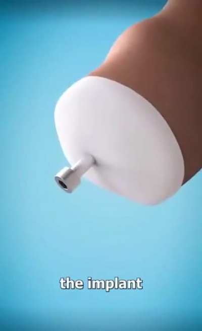 A bionic arm