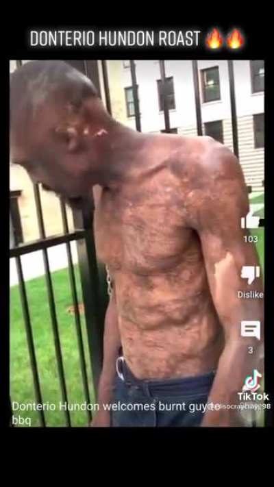 Making fun of a burn victim