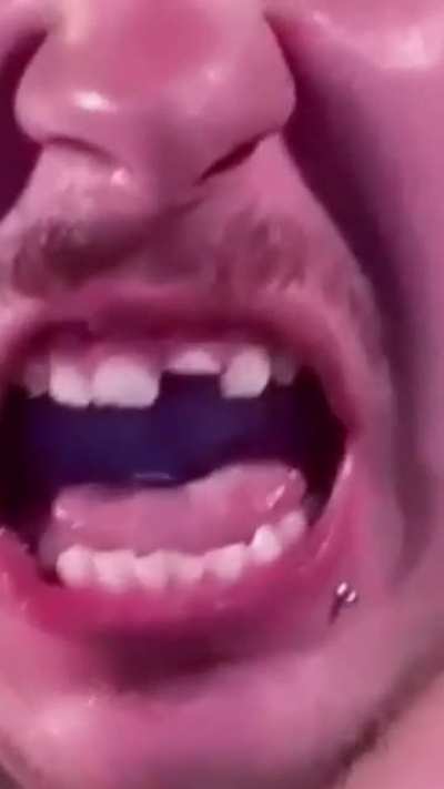 Rattrap (accidental) Tooth Removal NSFW * IG: footage_over_fear