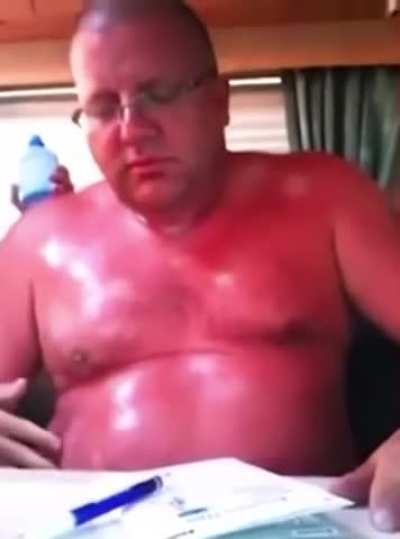 Worst sunburn I&rsquo;ve ever seen Xpost r/GIFtedIndividuals