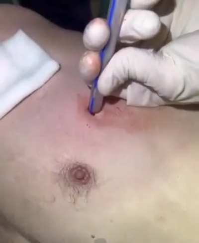 (REUPLOAD) Couldn&rsquo;t find the original so uploading the copy I have. Ukraine Chest seals and chest tube insertion.