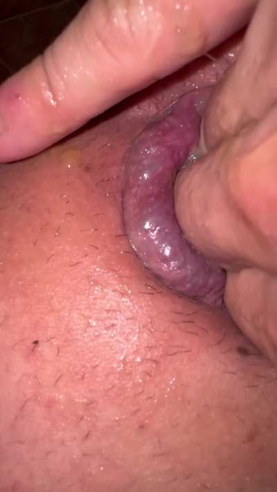 Look at my prolapse, I can put almost 5 fingers in. My gf managed to fist me, but my fist for my anal is a lil too big.