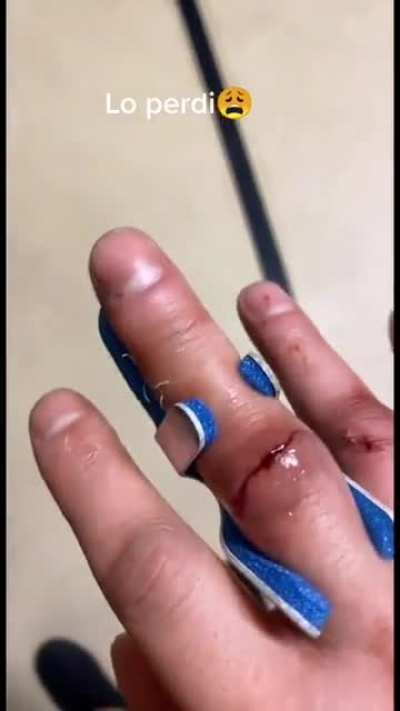 Guy loses finger at the infamous punch machine