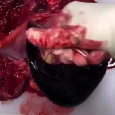 Heart-attack with cardiac perforation and tamponade (autopsy)