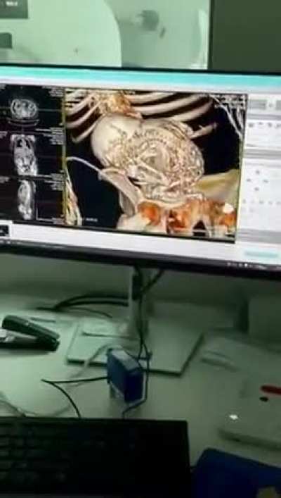 Patient went for a bladder stone turns out it&rsquo;s a Calcified baby never birthed