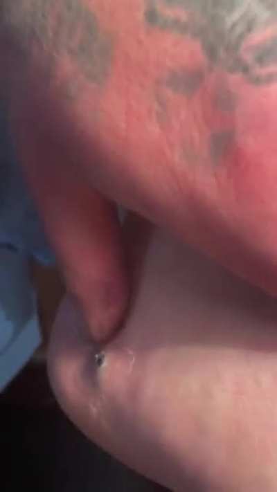 My bro removing a bb from his foot with a magnet