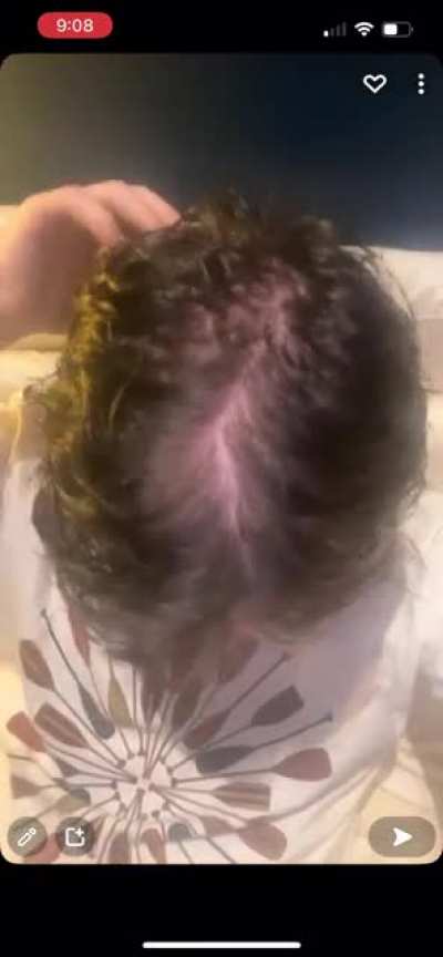 I&rsquo;m 17, is this male pattern balding