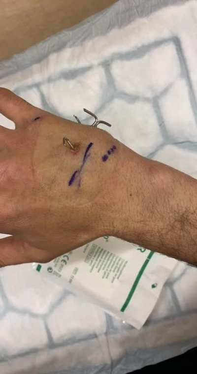Well, this sucks even more. I&rsquo;ve apparently broke my broken hand