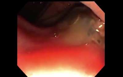 Why we wash our Vegetables WELL before eating them || 40-year old w/ the Parasite "Liver Fluke" contracted from eating Watercress. This is an Endoscope videoing the parasite entering his Duodenum coming from his Pancreas