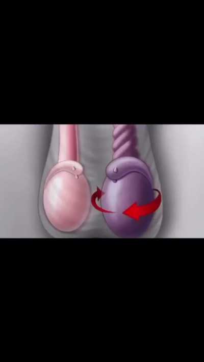 testicular torsion