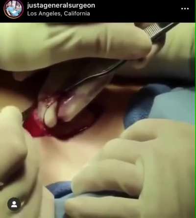 Correction of syndactyly