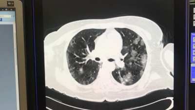 SARS-CoV2 infection
