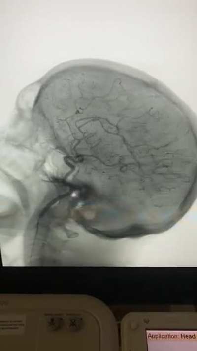 3D Spin Carotid Cerebral Angiogram. Love working IR