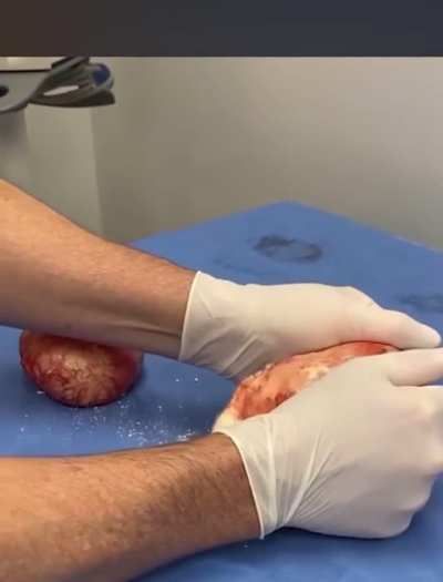 Calcified Implants
