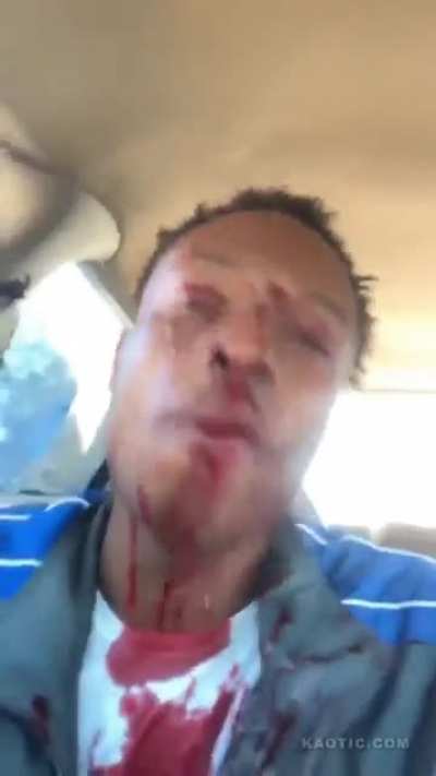 Thug Goes On Live After Getting Shot In The Face