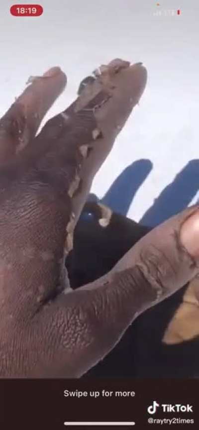how does that much skin come off&hellip;
