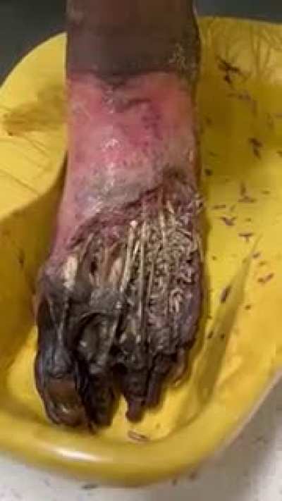 Maggots eating a man&rsquo;s foot&hellip; this is fucking disgusting.